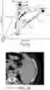 Fig. 07 - Detection and/or correction of residual iodine artifacts in spectral computed tomography (CT) imaging