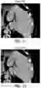 Fig. 08 - Detection and/or correction of residual iodine artifacts in spectral computed tomography (CT) imaging