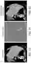 Fig. 09 - Detection and/or correction of residual iodine artifacts in spectral computed tomography (CT) imaging