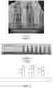 Fig. 02 - Uniform bottom spacer for VFET devices