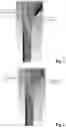 Fig. 03 - Spark plug with polymer sealing ring