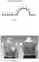 Fig. 02 - Post Operative Bra for Preventing Truncal Lymphedema