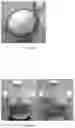 Fig. 03 - Post Operative Bra for Preventing Truncal Lymphedema