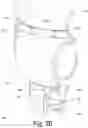 Fig. 04 - FEMUR/HIP PROTECTION SYSTEM