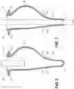 Fig. 03 - Orophrangeal glove for use with a rigid bronchscope and a method