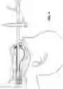 Fig. 04 - Orophrangeal glove for use with a rigid bronchscope and a method