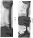 Fig. 05 - Esophageal deflection device