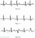 Fig. 19 - Systems, articles and methods for cardiology sensory technology