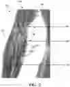 Fig. 03 - Method and system for neurohydrodissection