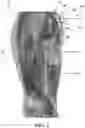 Fig. 04 - Method and system for neurohydrodissection