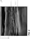 Fig. 05 - Method and system for neurohydrodissection
