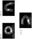 Fig. 07 - MYOCARDIAL BLOOD FLOW WITH RELIABILITY FEATURE