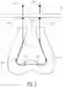 Fig. 03 - Filamentary fixation device