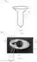 Fig. 03 - Suture crimp plate