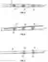 Fig. 04 - NEEDLE FOR DELIVERY OF DERMAL FILLER THREADS
