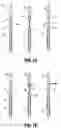Fig. 07 - Circular stapling device with alignment splines