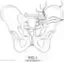 Fig. 02 - Systems for and methods of preparing a sacroiliac joint for fusion