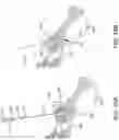 Fig. 58 - Systems for and methods of preparing a sacroiliac joint for fusion