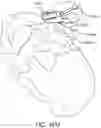 Fig. 64 - Systems for and methods of preparing a sacroiliac joint for fusion