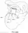Fig. 65 - Systems for and methods of preparing a sacroiliac joint for fusion