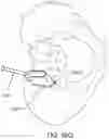 Fig. 68 - Systems for and methods of preparing a sacroiliac joint for fusion