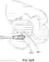 Fig. 69 - Systems for and methods of preparing a sacroiliac joint for fusion