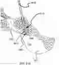 Fig. 80 - Systems for and methods of preparing a sacroiliac joint for fusion