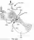 Fig. 81 - Systems for and methods of preparing a sacroiliac joint for fusion
