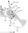 Fig. 82 - Systems for and methods of preparing a sacroiliac joint for fusion