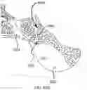 Fig. 86 - Systems for and methods of preparing a sacroiliac joint for fusion