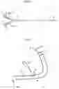 Fig. 03 - THREE FILTERS CATHETER FOR BRAIN PROTECTION AND METHOD