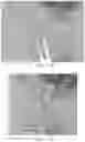 Fig. 06 - Capture-tool for manipulating and entubulating nerves