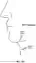 Fig. 131 - Pixel array medical systems, devices and methods