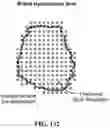 Fig. 138 - Pixel array medical systems, devices and methods