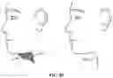 Fig. 85 - Pixel array medical systems, devices and methods