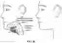 Fig. 86 - Pixel array medical systems, devices and methods