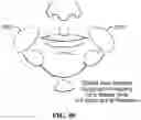Fig. 89 - Pixel array medical systems, devices and methods