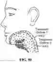 Fig. 90 - Pixel array medical systems, devices and methods