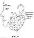 Fig. 91 - Pixel array medical systems, devices and methods