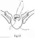 Fig. 07 - Ultrasonic scalpel bit