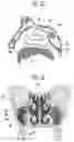 Fig. 17 - APPARATUS FOR PUNCTURING MAXILLARY SINUS