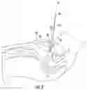 Fig. 03 - INSTRUMENTS AND METHODS FOR MYOMA RETRACTION