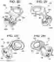 Fig. 05 - Multipoint fixation implants
