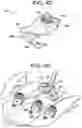 Fig. 13 - Multipoint fixation implants