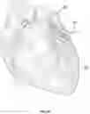 Fig. 03 - Method and device for interventricular septal ablation