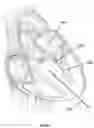 Fig. 04 - Method and device for interventricular septal ablation