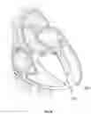 Fig. 05 - Method and device for interventricular septal ablation