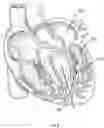 Fig. 06 - Method and device for interventricular septal ablation