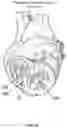 Fig. 08 - Method and device for interventricular septal ablation
