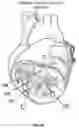 Fig. 10 - Method and device for interventricular septal ablation